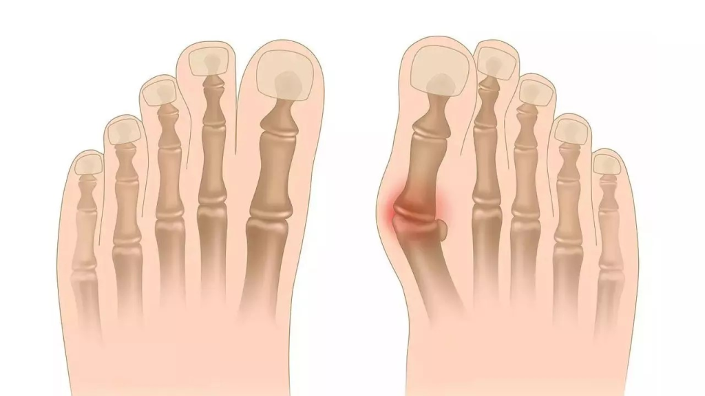 علل و عوامل ایجاد کننده انحراف شست پا