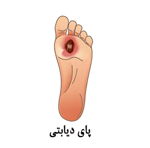پای دیابتی چیست؟