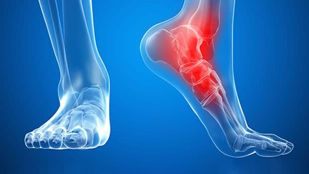 علائم شکستگی مچ پا