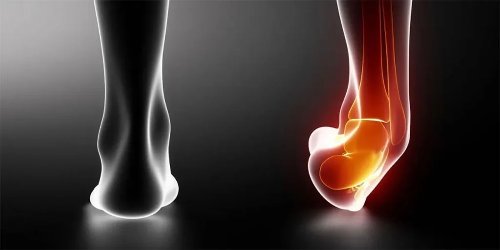 نحوه تشخیص دررفتگی مچ پا